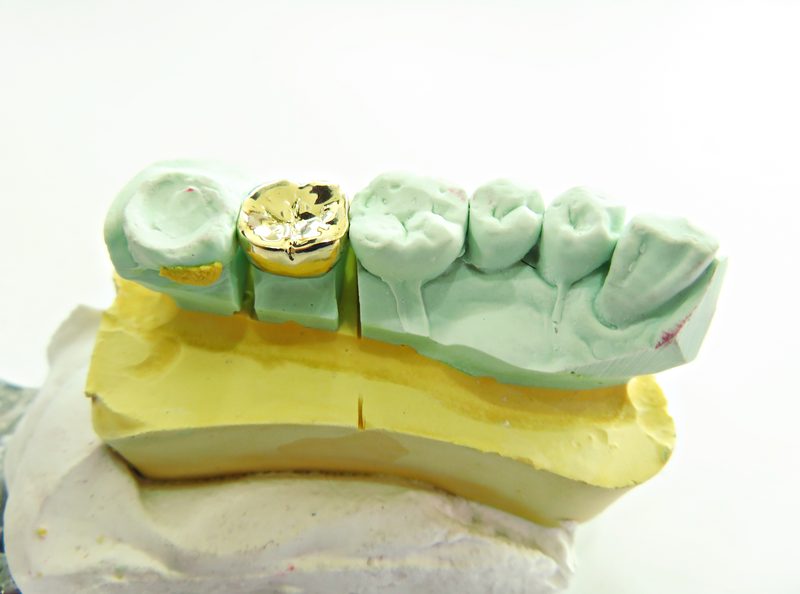 Full gold crown — durable dental restoration
